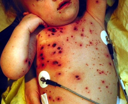 Neonatal chickenpox | perri dermatology
