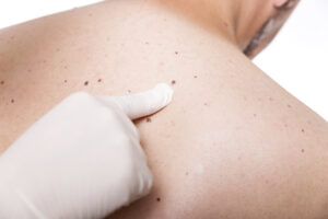 Skin exam example | perri dermatology