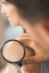 Spot on skin under magnifying glass | perri dermatology