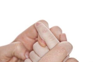 A child model demonstrates a wart on a finger