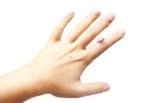 Hand with large wart on index finger | perri dermatology