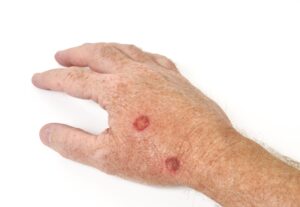 Hand with two large red warts | perri dermatology