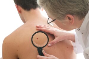 Model of doctor examining a mole | perri dermatology