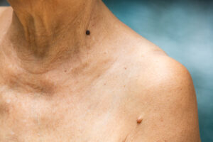 Shoulder with warts | perri dermatology