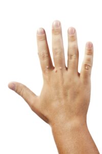 Hand with warts | perri dermatology