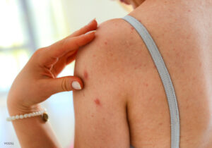 Close up of shoulder of woman with skin cancer mark