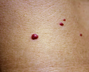 Red moles | perri dermatology