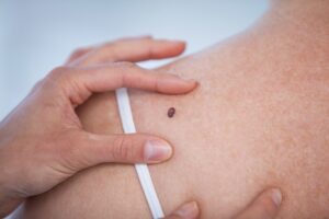 Mole being held for examination | perri dermatology