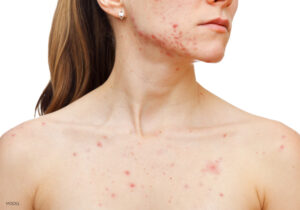 Adult acne | perri dermatology