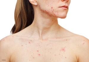 Adult acne