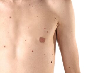 Male chest covered in moles