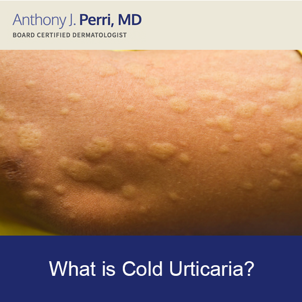 Model Example of cold Urticaria