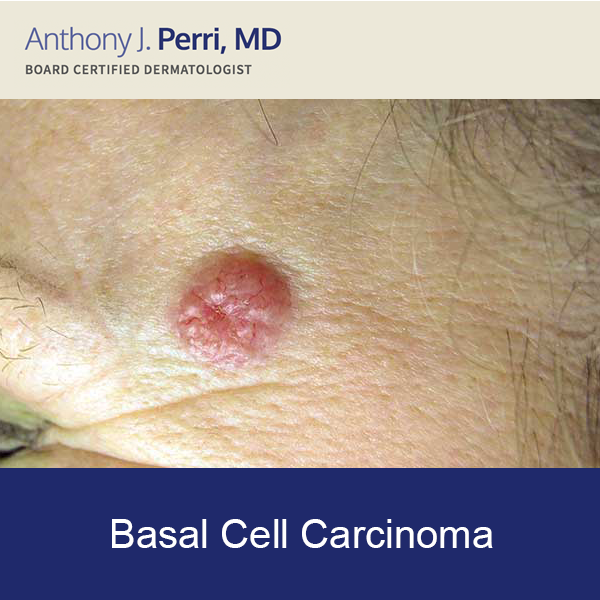 Basal Cell Carcinoma Near the Eyes