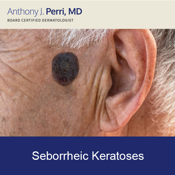 Example of seborrheic keratoses
