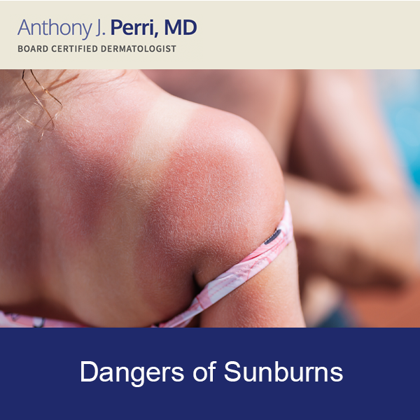 Model shows common sunburn developed while swimming