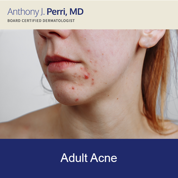 A Model Demonstrates Adult Acne