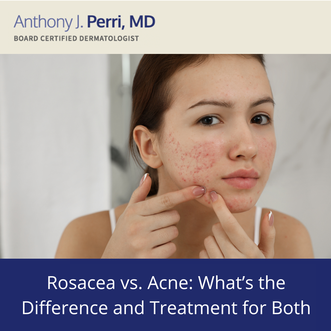 Model demonstrating what rosacea or acne could look like | perri dermatology