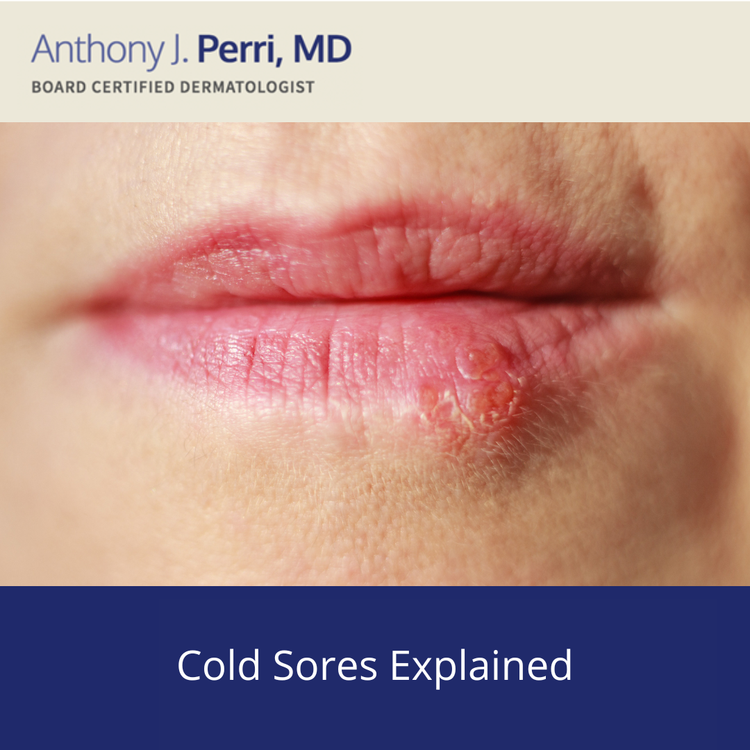 Image of cold sores on lower lip | perri dermatology