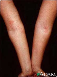 An example of eczema in the arms