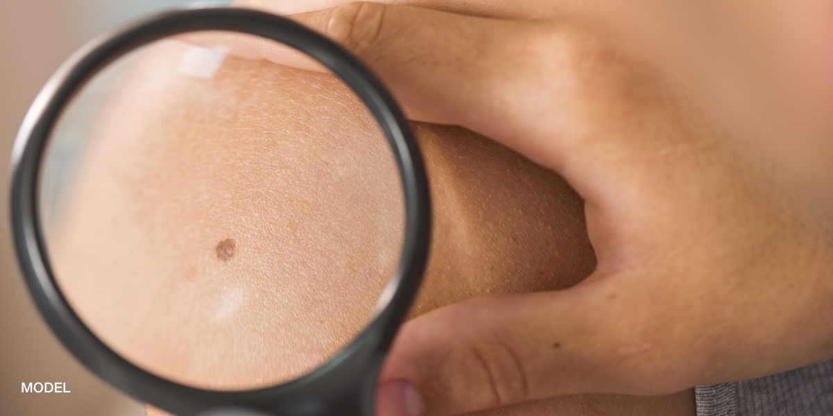 Magnifying glass on a persons mole | perri dermatology